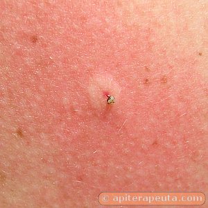 enrojecimiento de la piel en la apiterapia con veneno de abeja HD